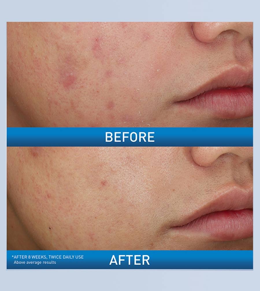 CeraVe Acne Foaming Cream Wash 150ml